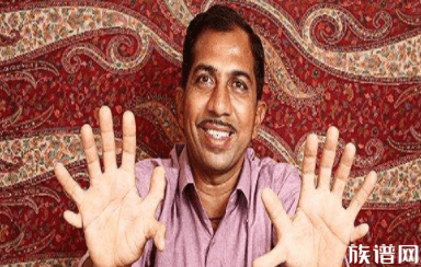 印度1岁男童有 34根指头 世界最多