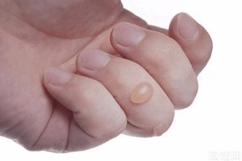 儿子割大腿三分之二皮肤救母，古代有哪些治疗烧伤的偏方？