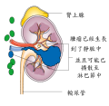 肾癌