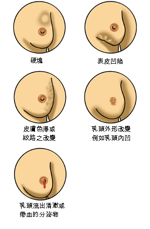 乳腺癌